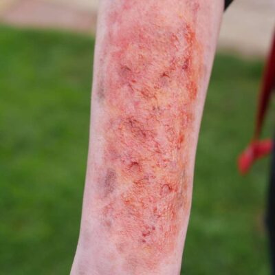 Emily Grant's burn